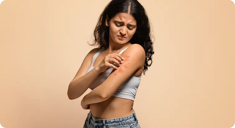 Eczema