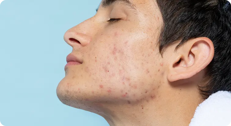 Acne