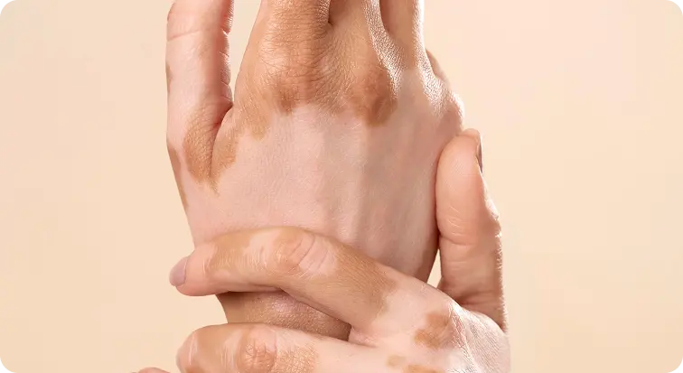 Vitiligo
